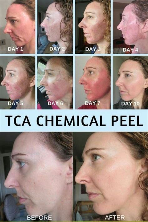 tb500-peptides-capsules
